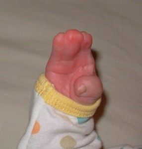 syndactyly 7232340_orig