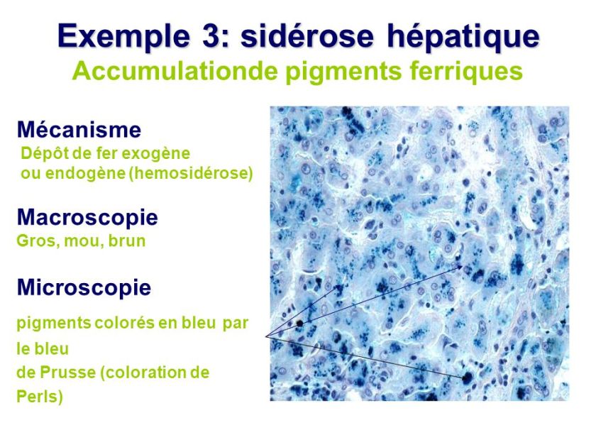 exemple3sidc3a9rosehc3a9patiqueaccumulationdepigmentsferriques